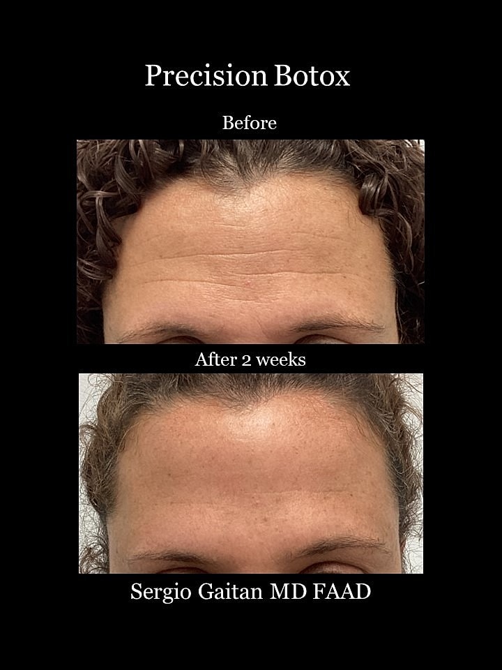 Botox Before & After