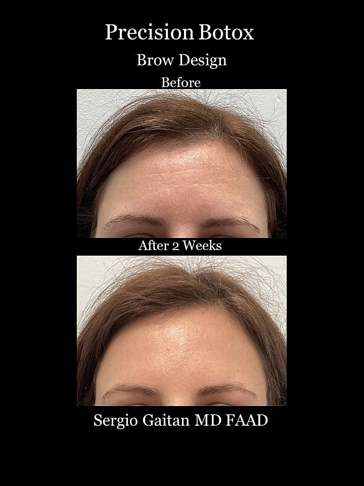 Botox Before & After