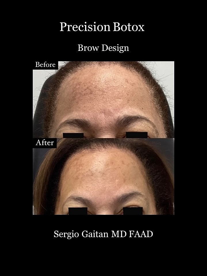 Botox Before & After