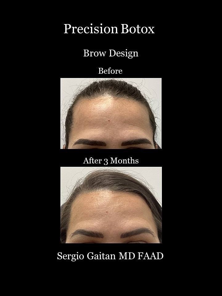 Botox Before & After