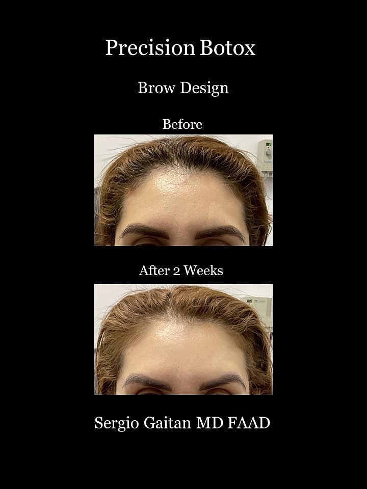 Botox Before & After