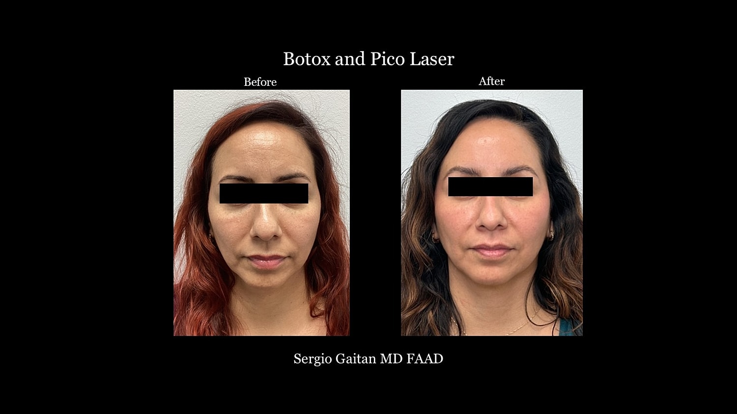 Botox Before & After