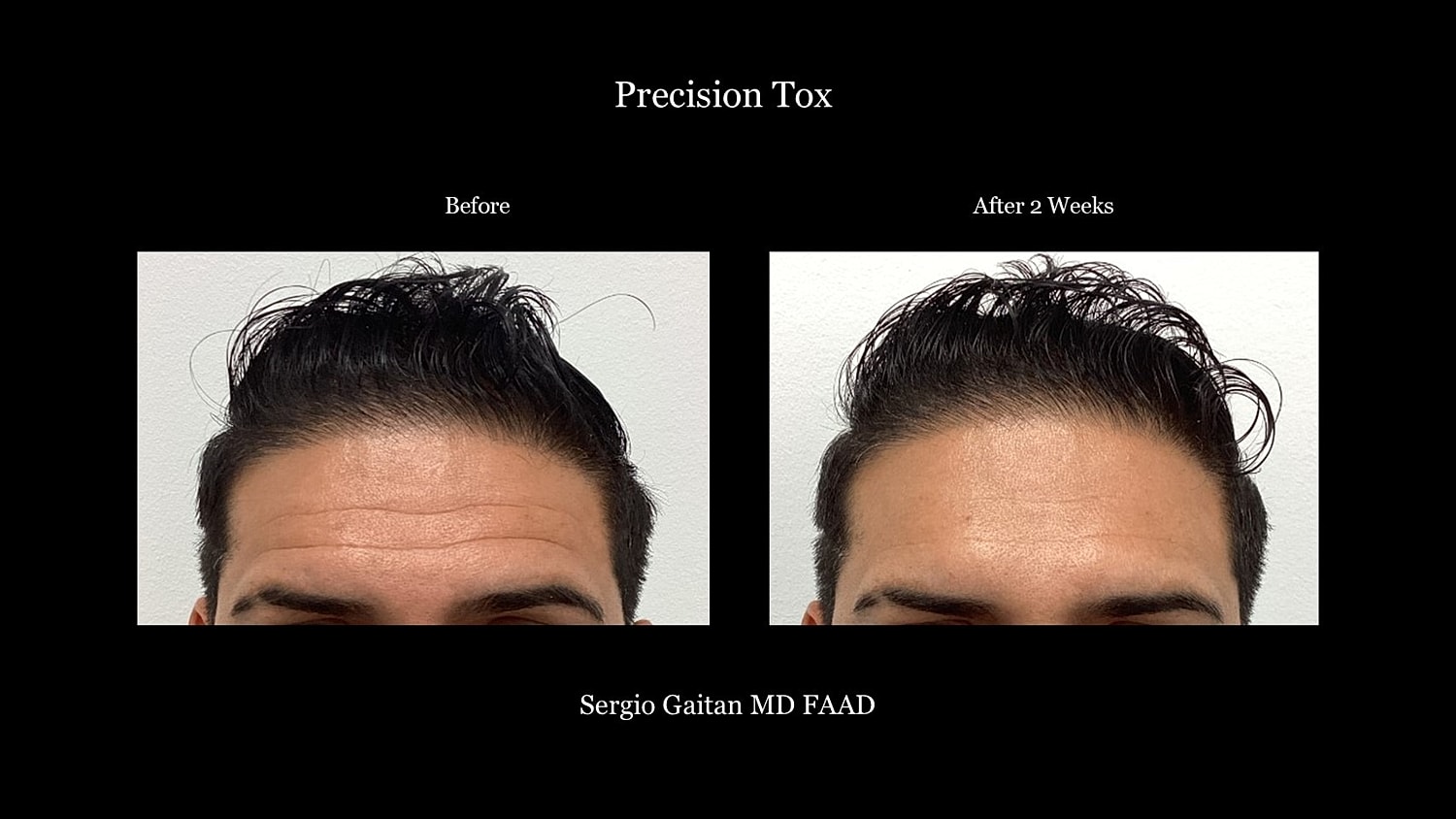 Botox Before & After