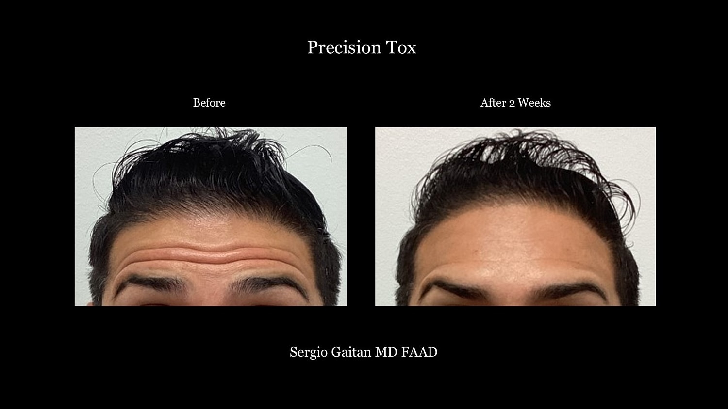 Botox Before & After