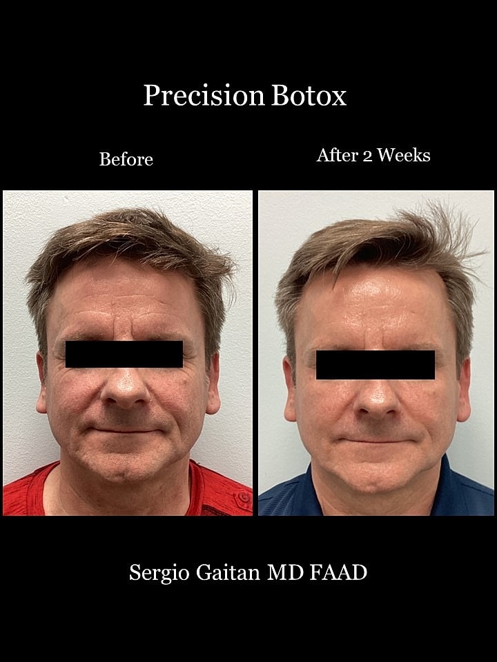 Botox Before & After