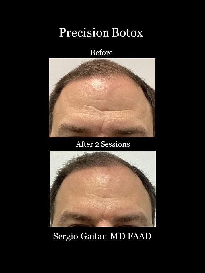 Botox Before & After
