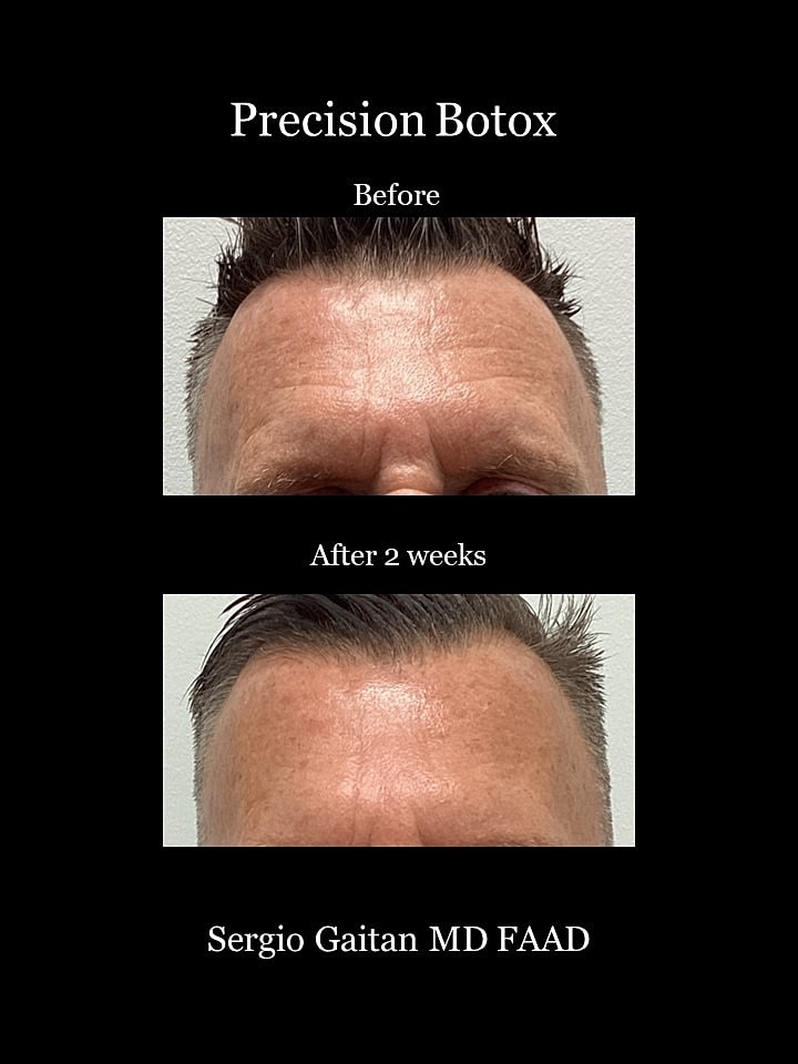 Botox Before & After