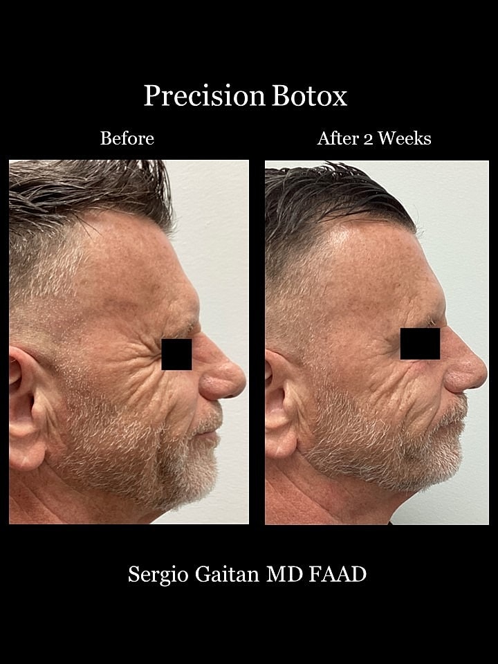 Botox Before & After