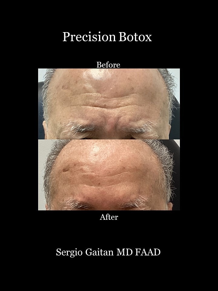 Botox Before & After