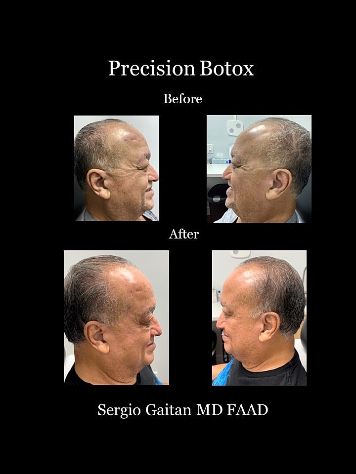 Botox Before & After