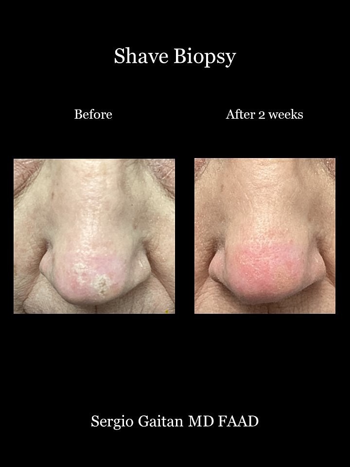 Shave Biopsy Before & After