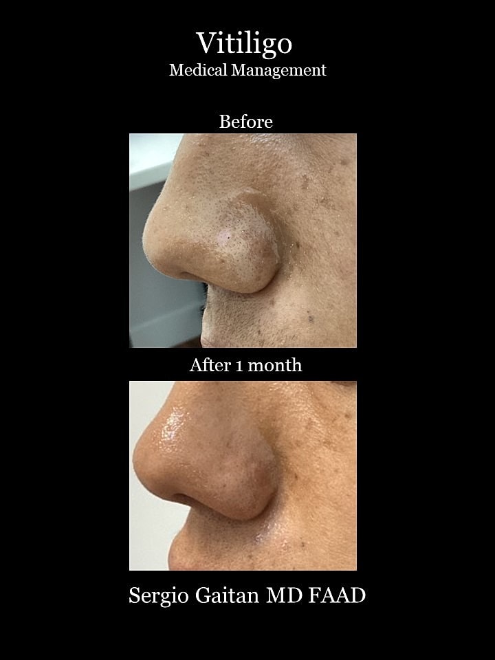 Vitiligo Before & After