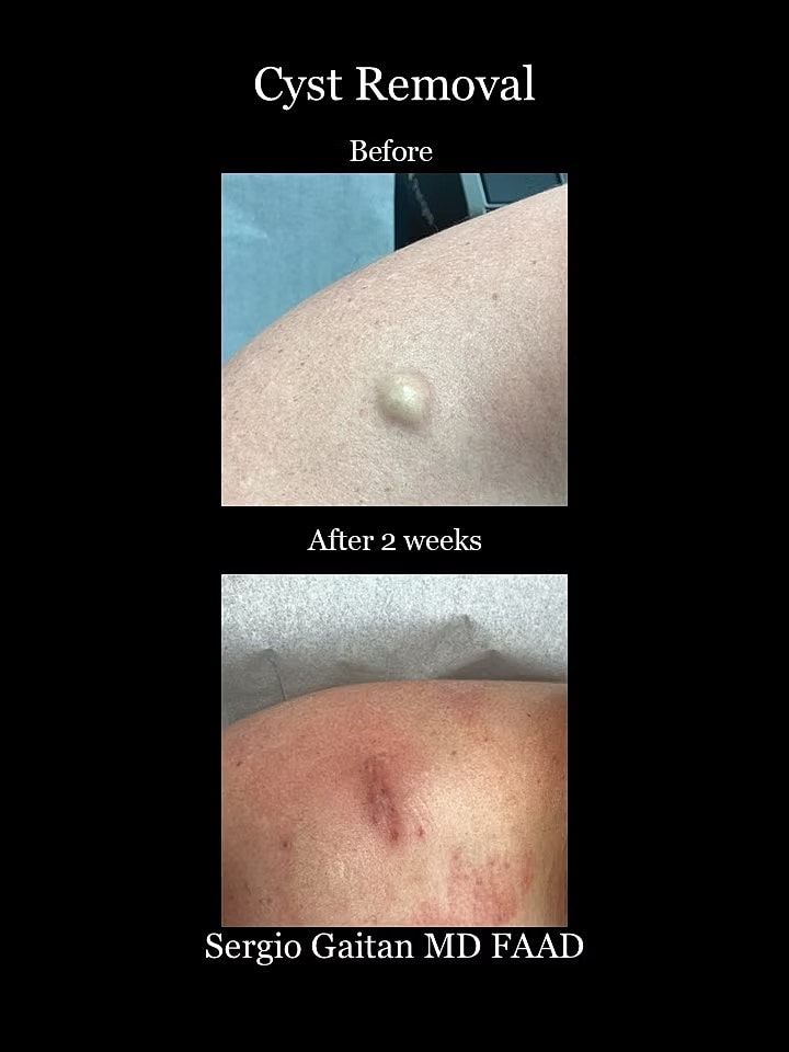 Cyst Removal  Before & After