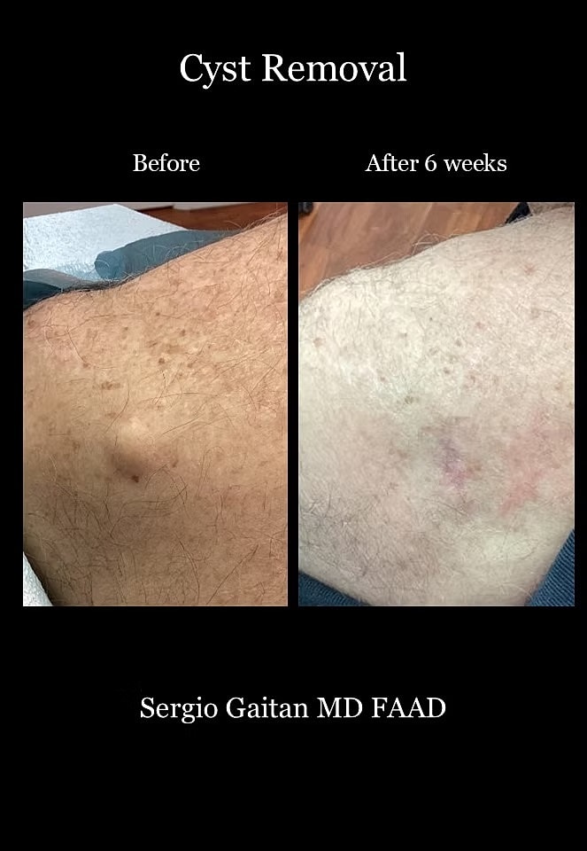 Cyst Removal  Before & After