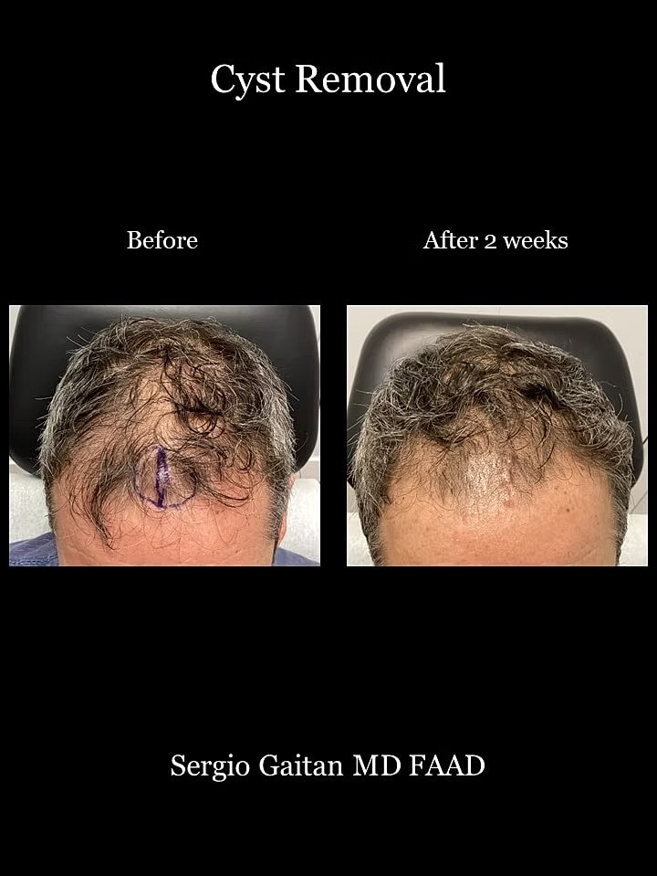 Cyst Removal  Before & After