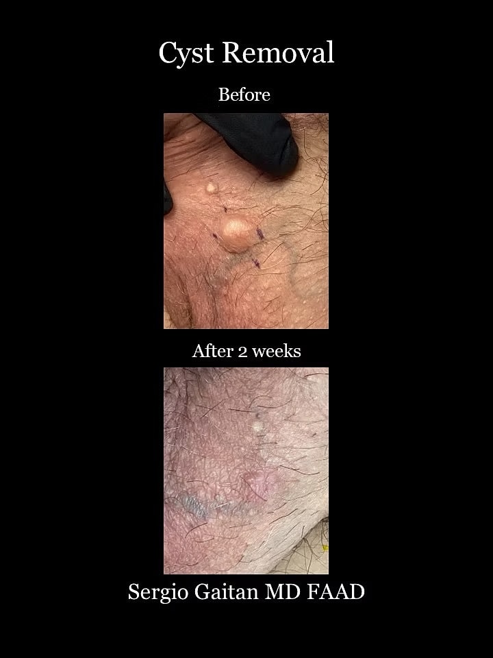 Cyst Removal  Before & After
