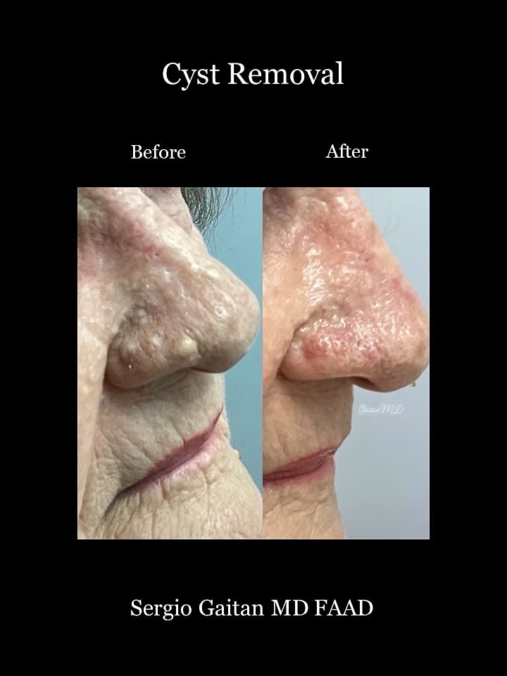 Cyst Removal  Before & After