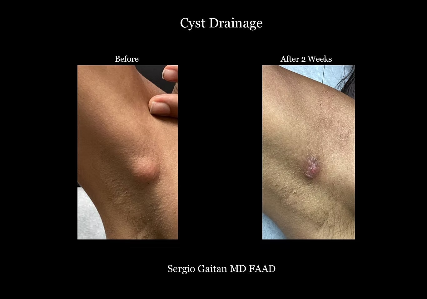 Cyst Removal  Before & After