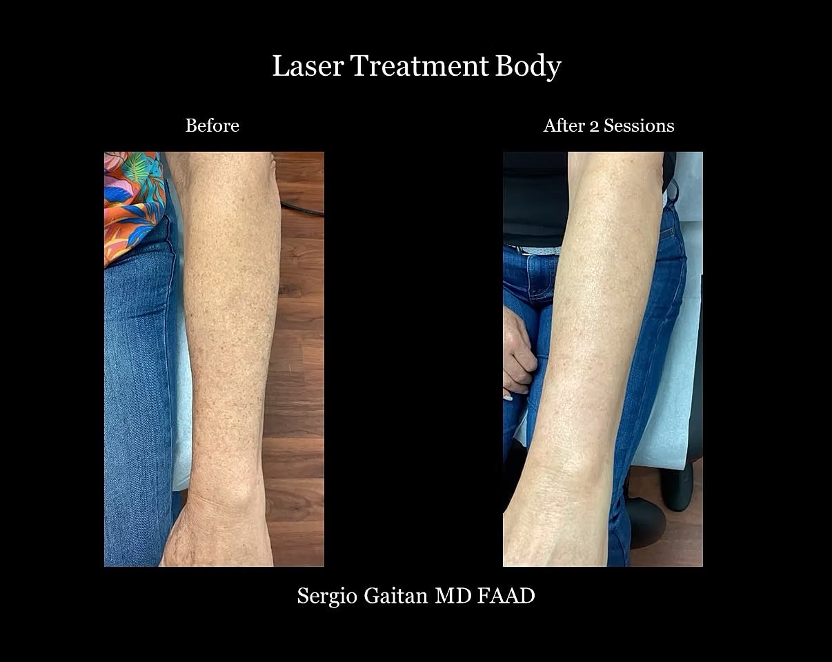 Laser Body Treatment Before & After
