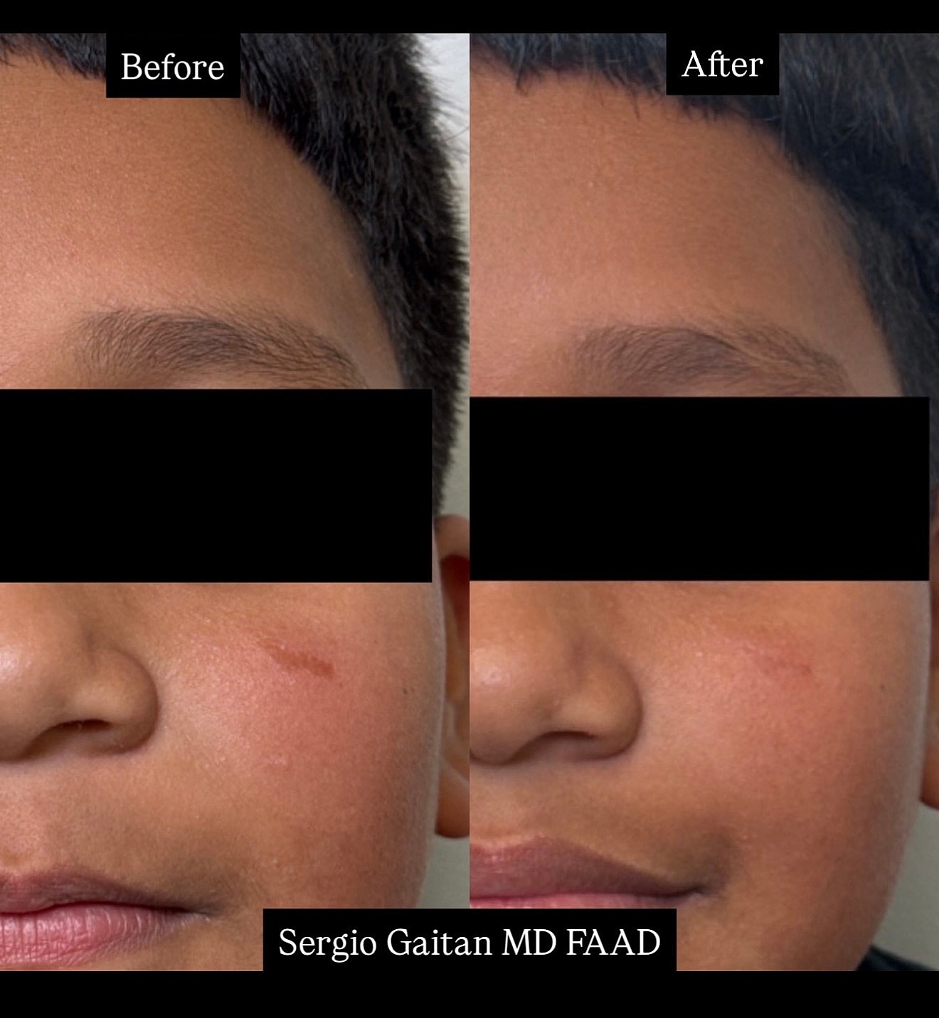Pico Laser Before & After