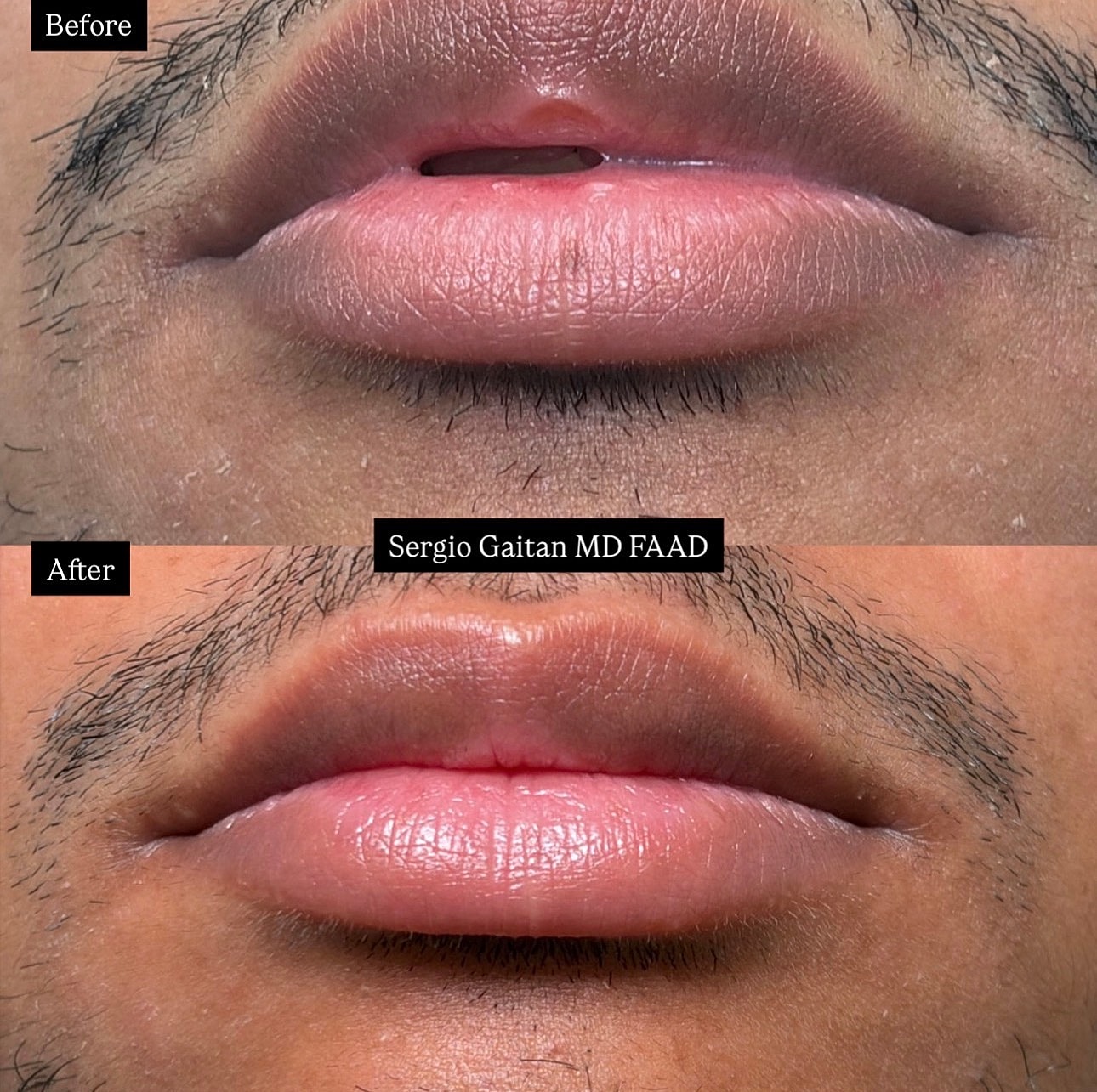 Pico Laser Before & After
