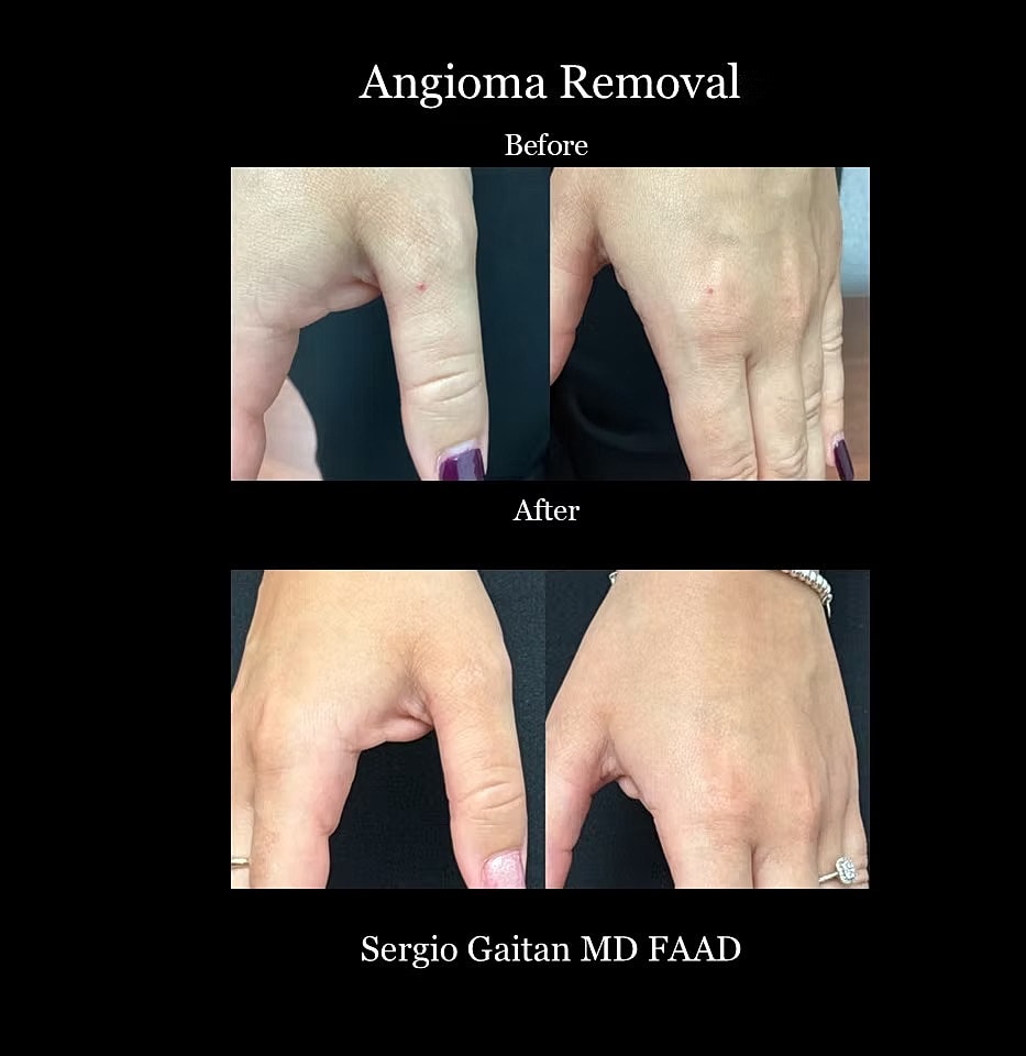 Laser Angioma Removal Before & After