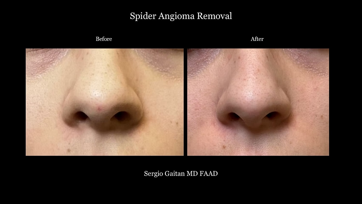 Laser Angioma Removal Before & After