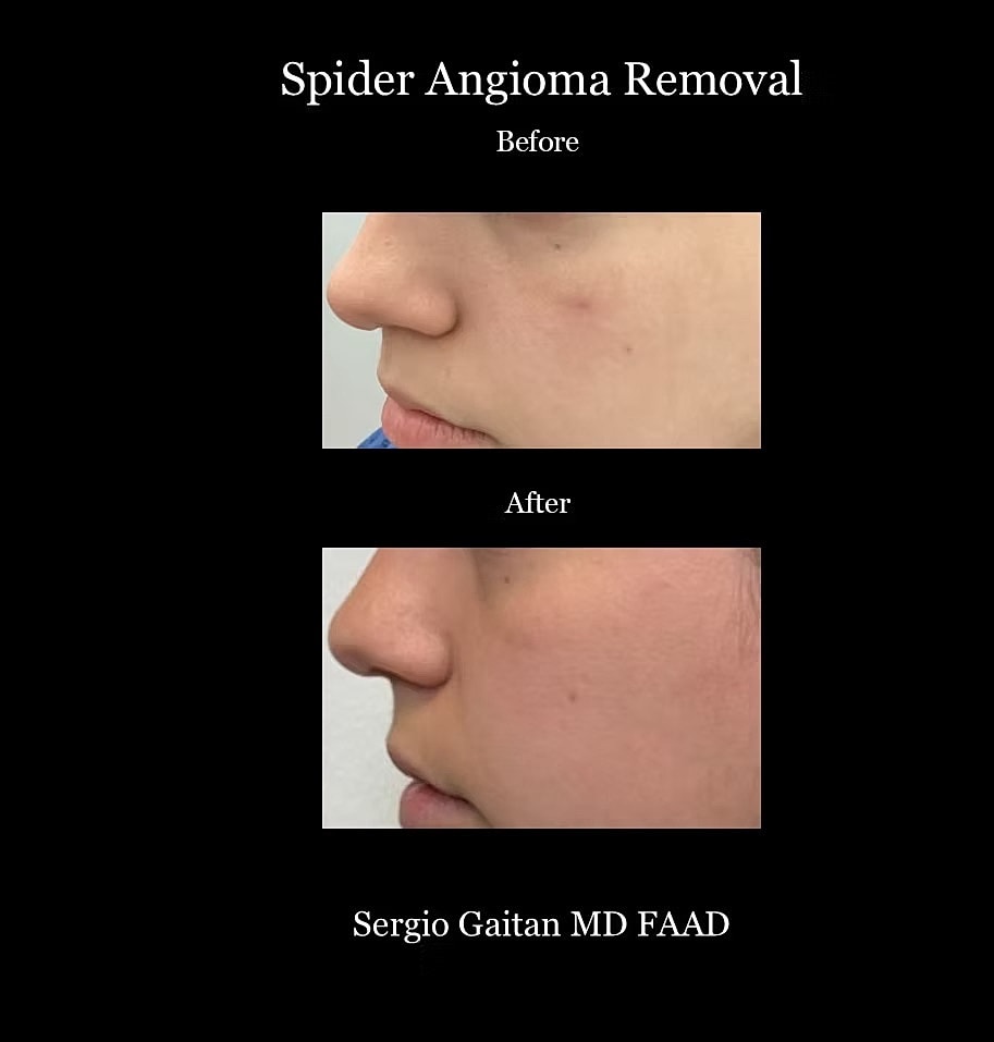 Laser Angioma Removal Before & After