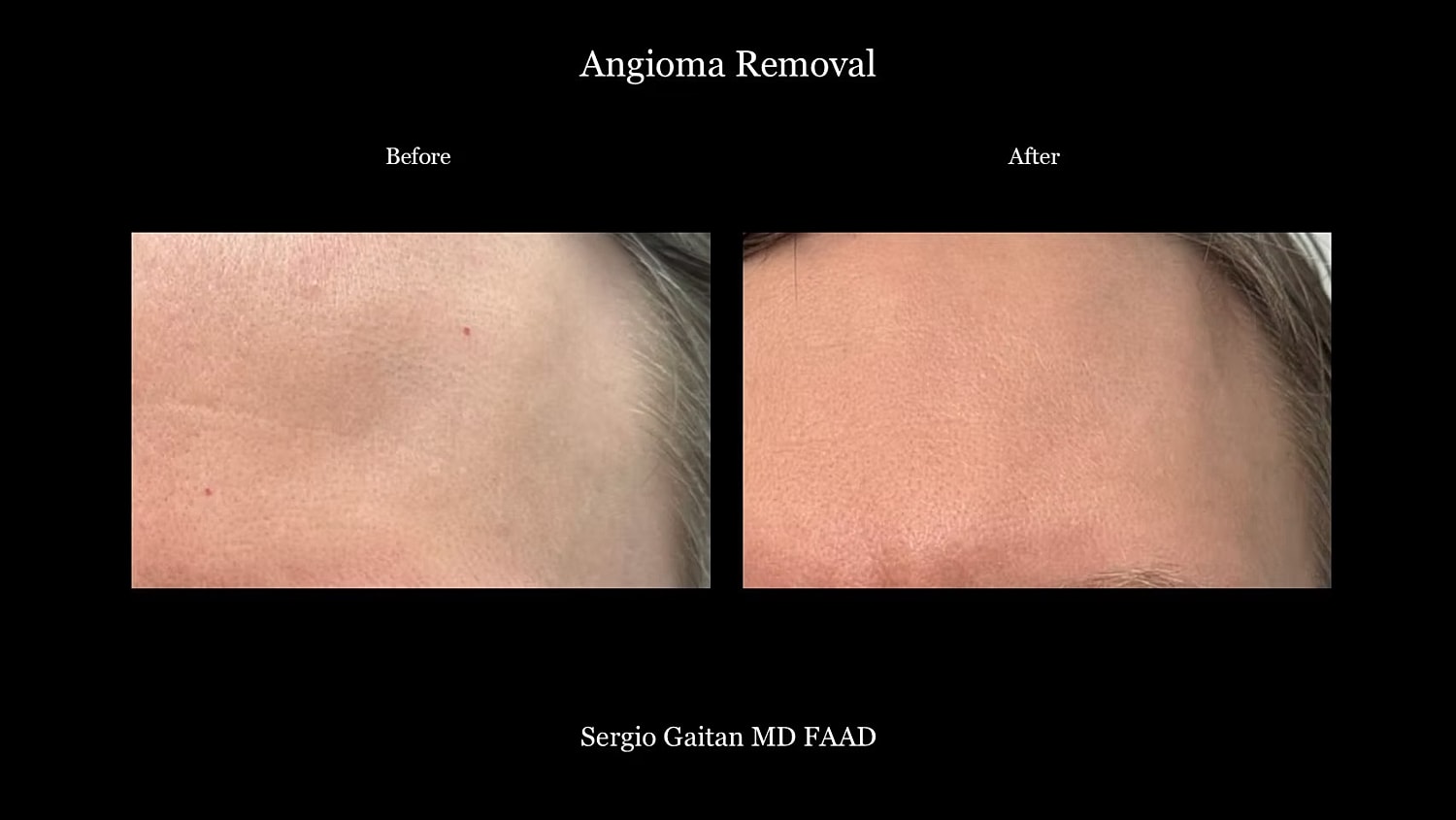 Laser Angioma Removal Before & After