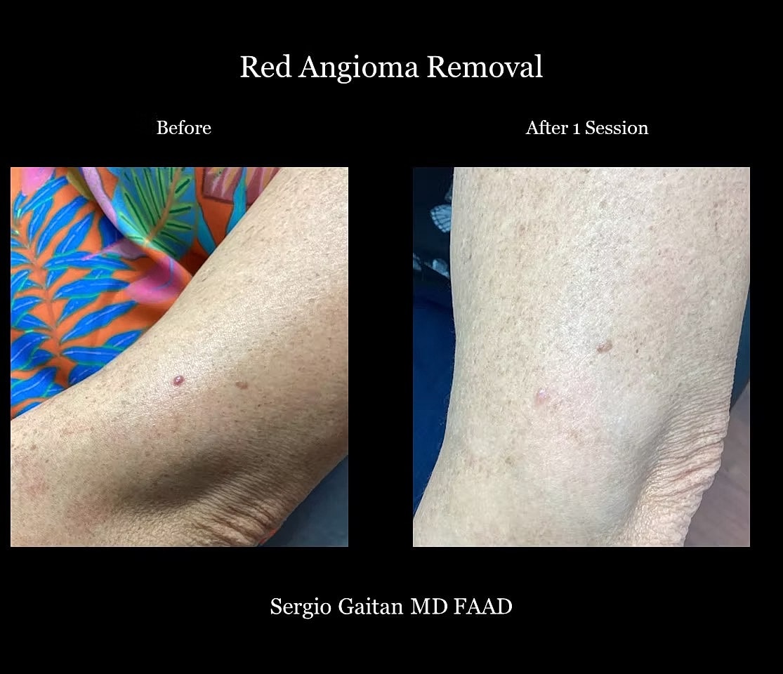 Laser Angioma Removal Before & After