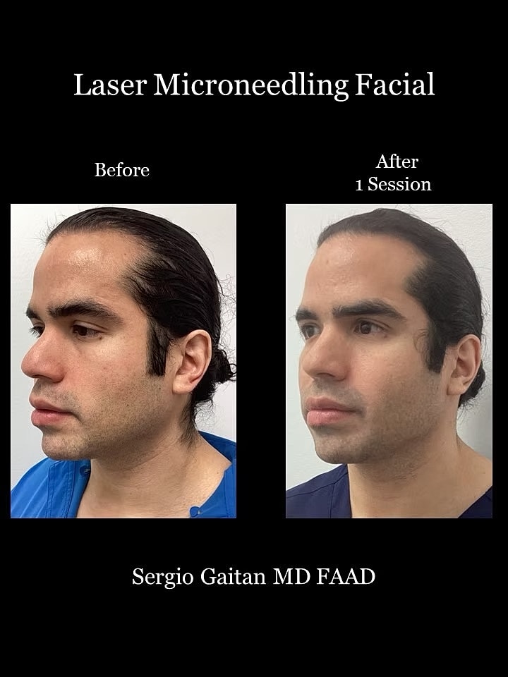 Laser Microneedling Before and After in Miami, Fl Before & After