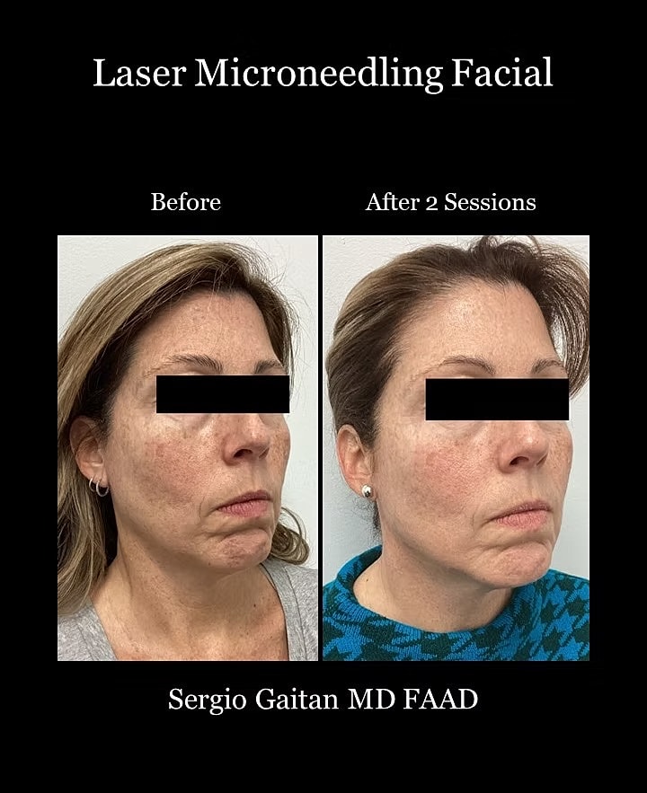 Laser Microneedling Before and After in Miami, Fl Before & After