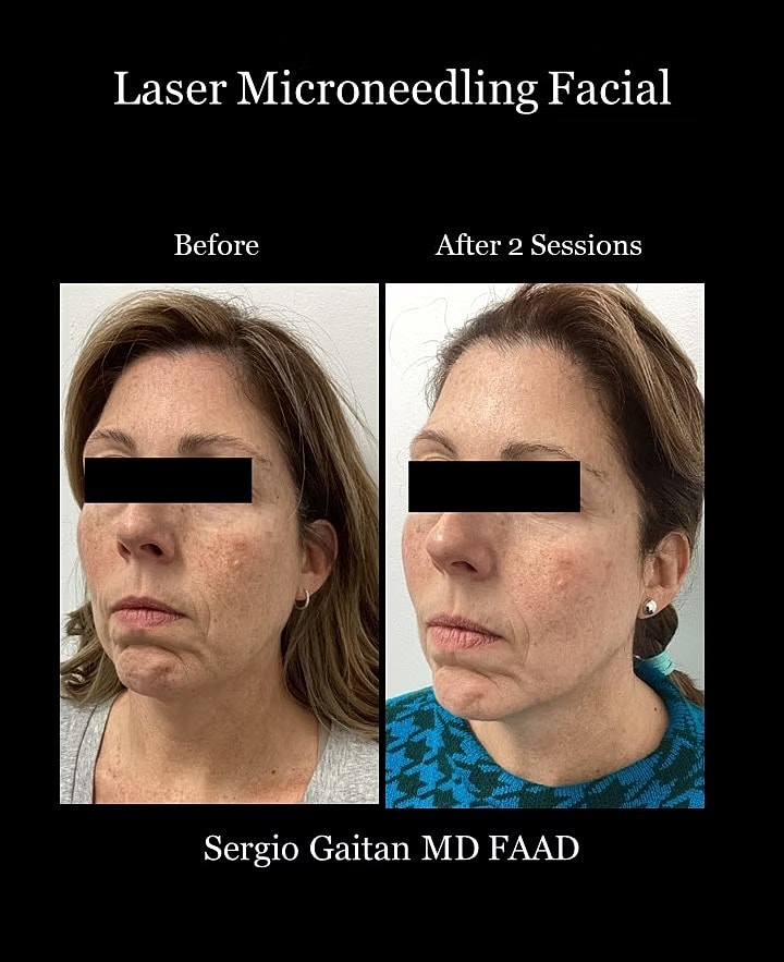 Laser Microneedling Before and After in Miami, Fl Before & After