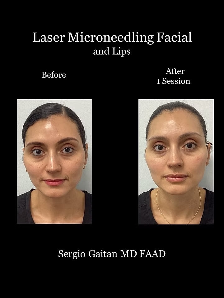 Laser Microneedling Before and After in Miami, Fl Before & After