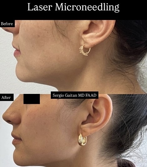 Laser Microneedling  Before & After
