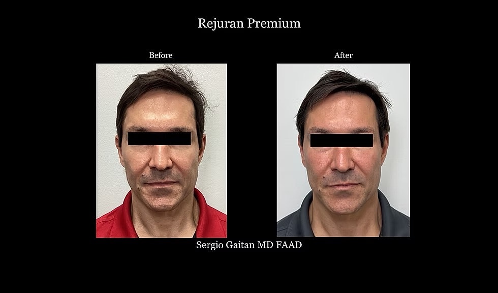 Before & After
