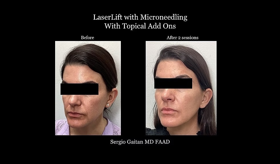 Before & After