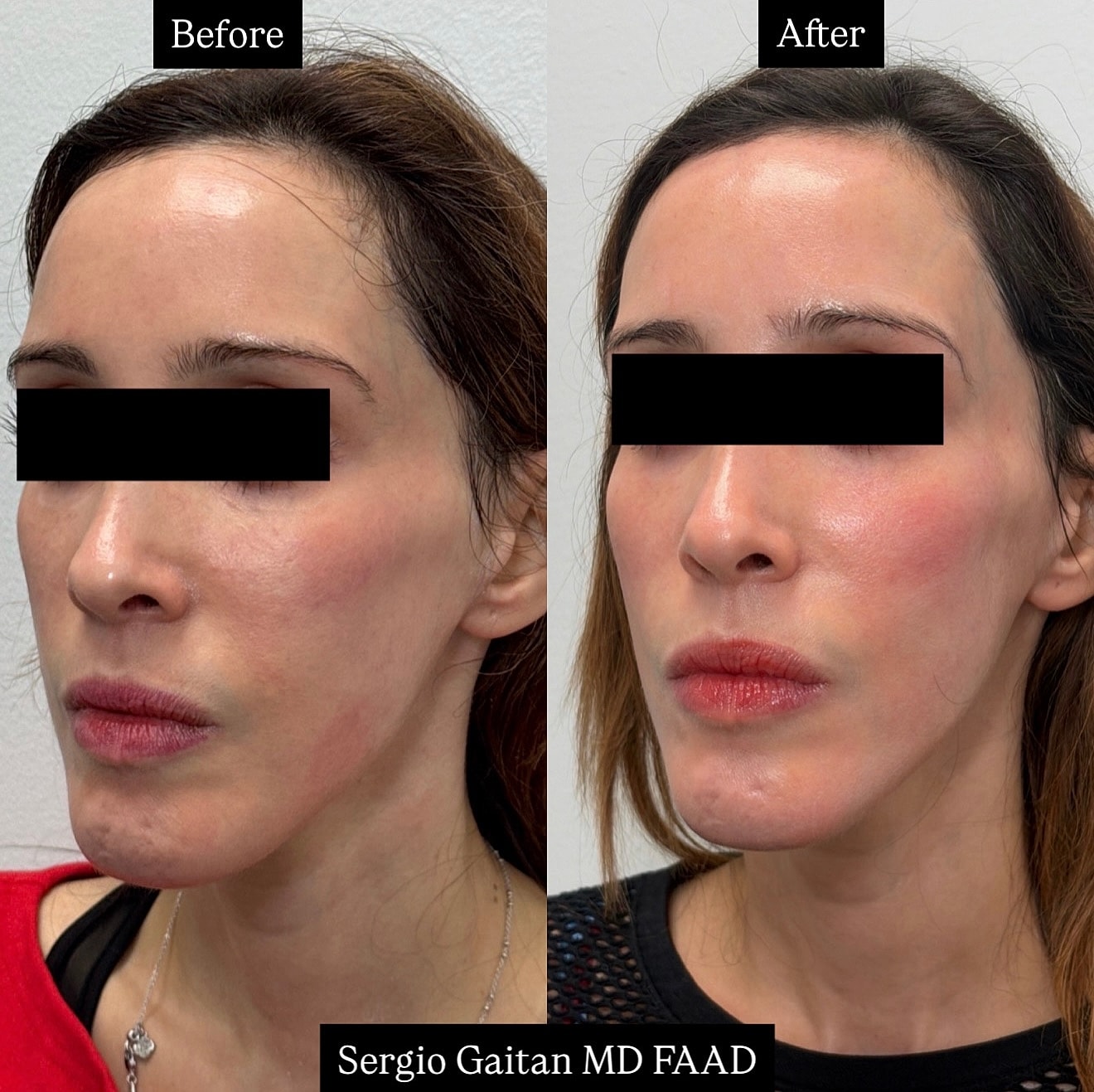 Rejuran  Before & After