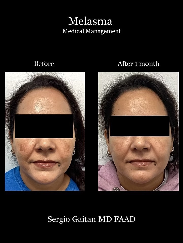 Melasma Before & After