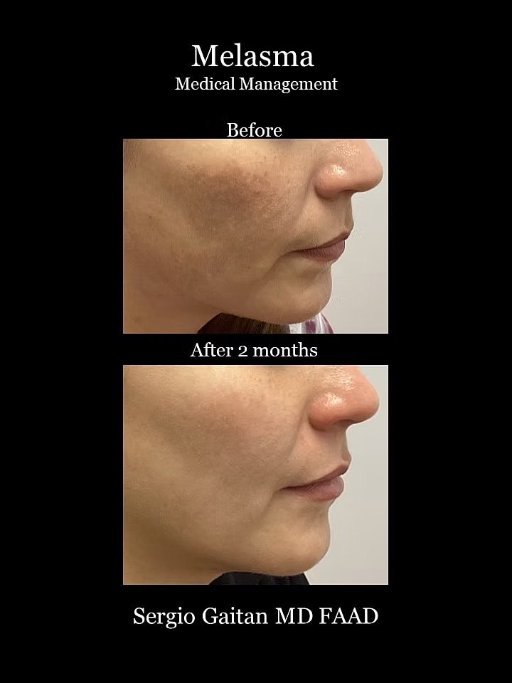 Melasma Before & After