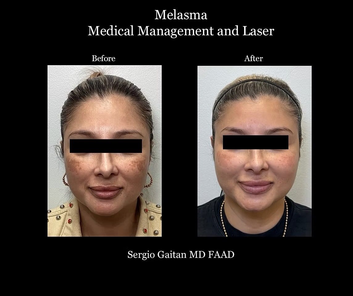 Melasma Before & After