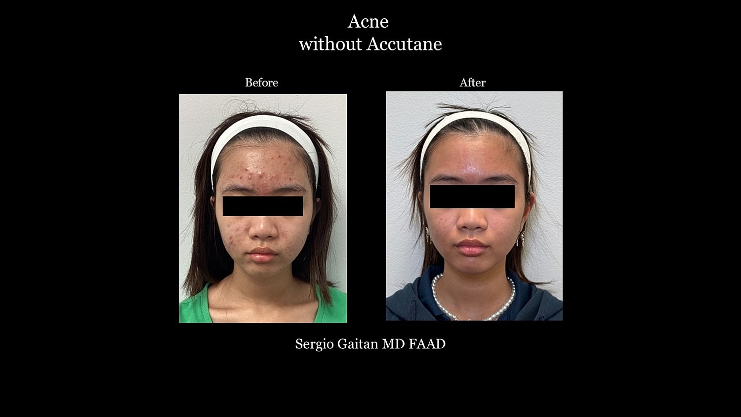 Acne Before & After