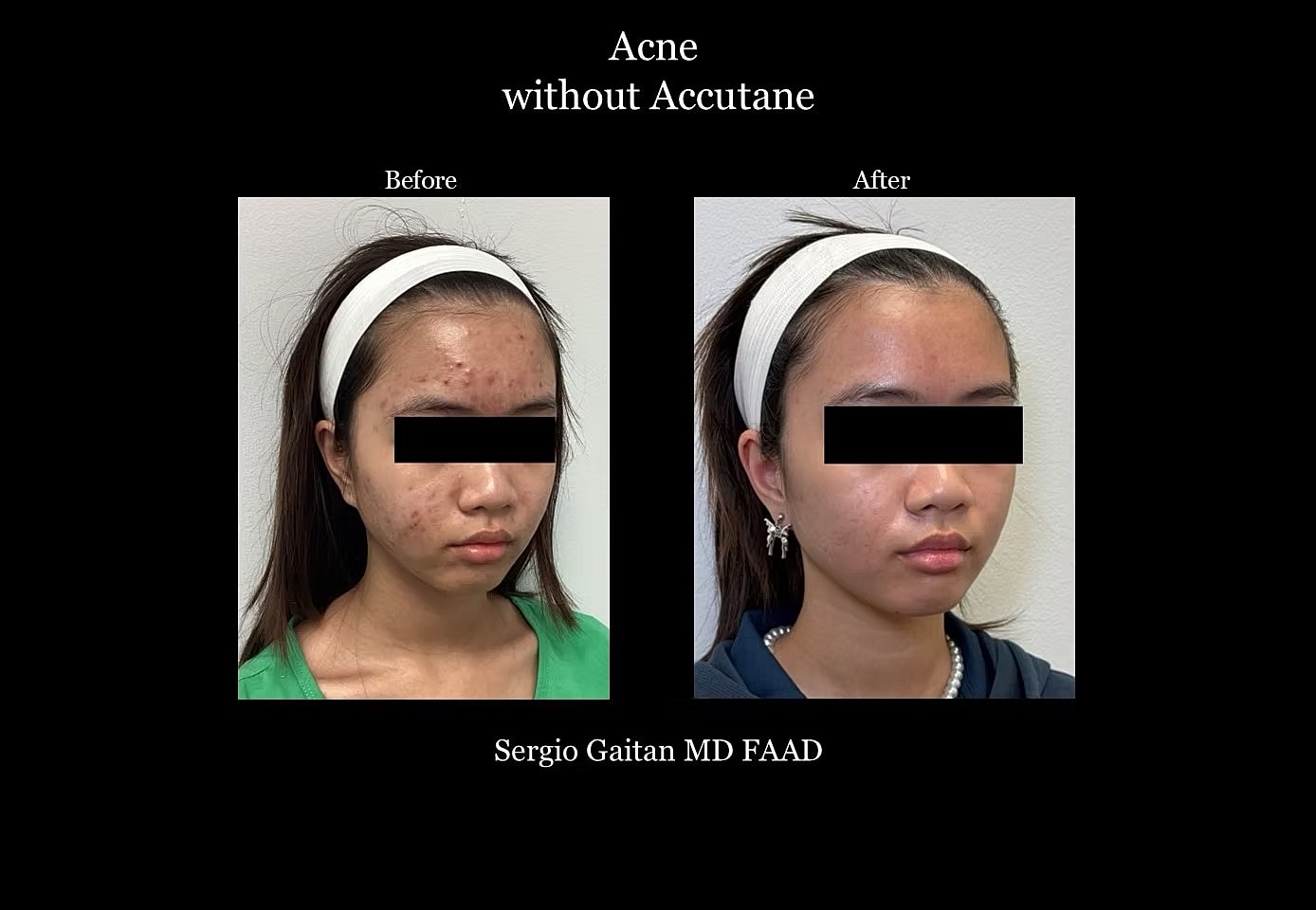 Acne Before & After