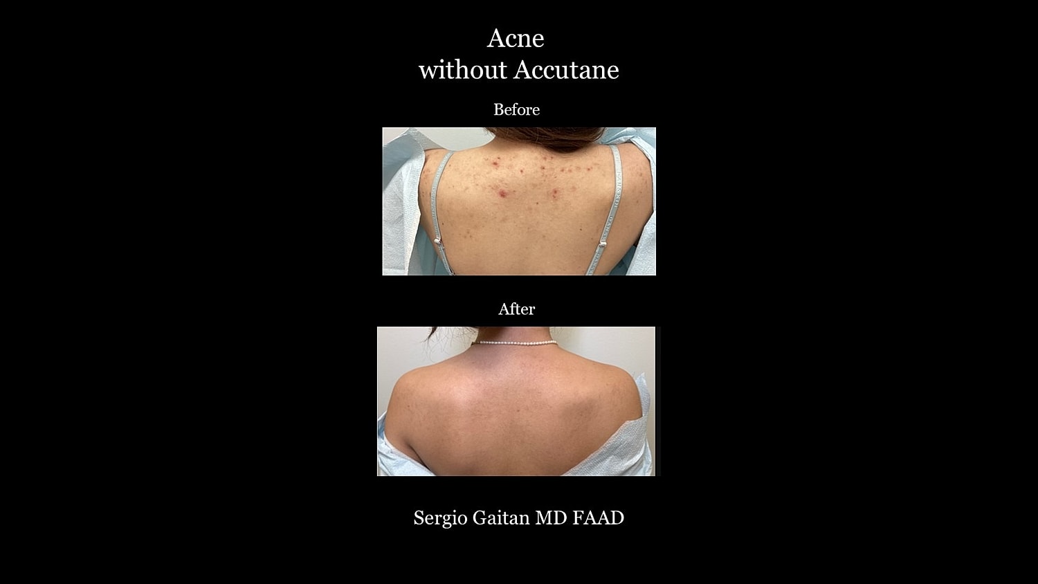 Acne Before & After
