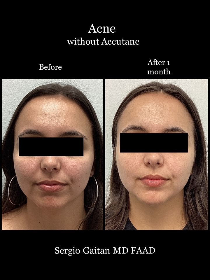 Acne Before & After