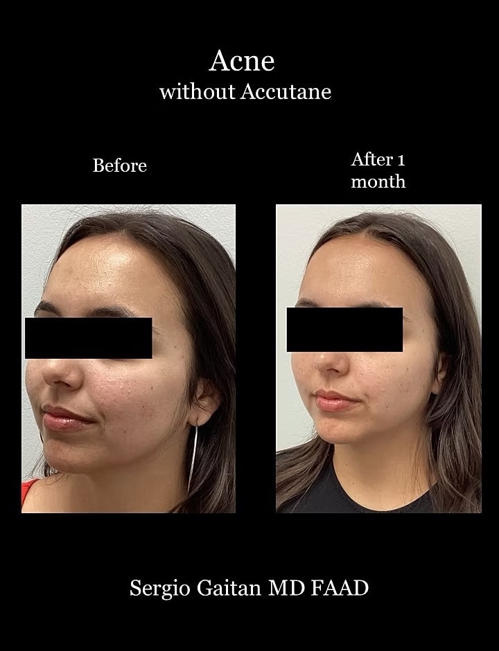 Acne Before & After