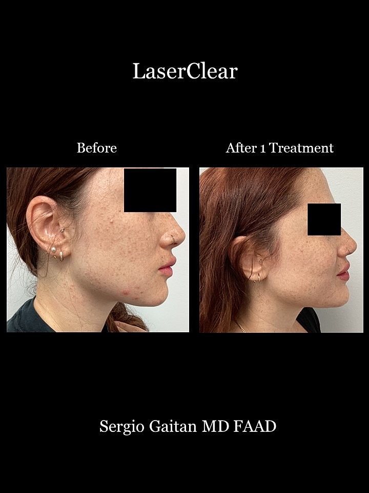 Acne Before & After
