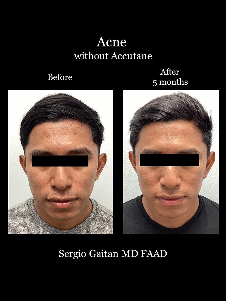 Acne Before & After