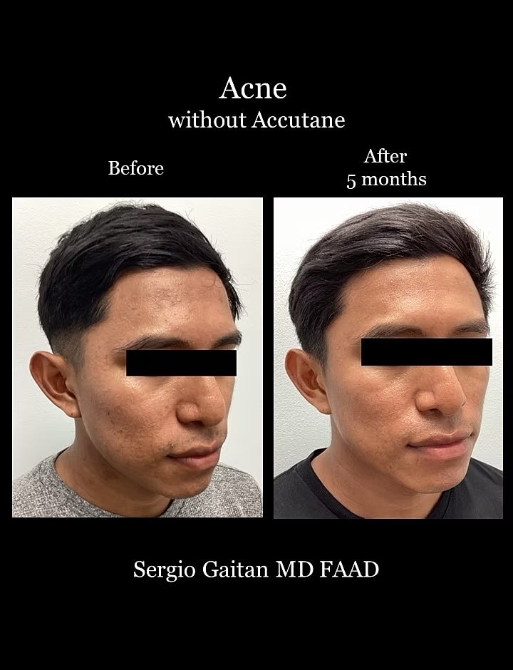 Acne Before & After