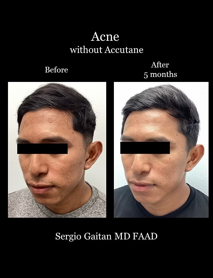 Acne Before & After